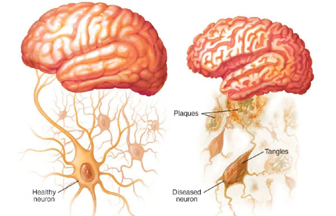 What’s Alzheimer’s complaint?