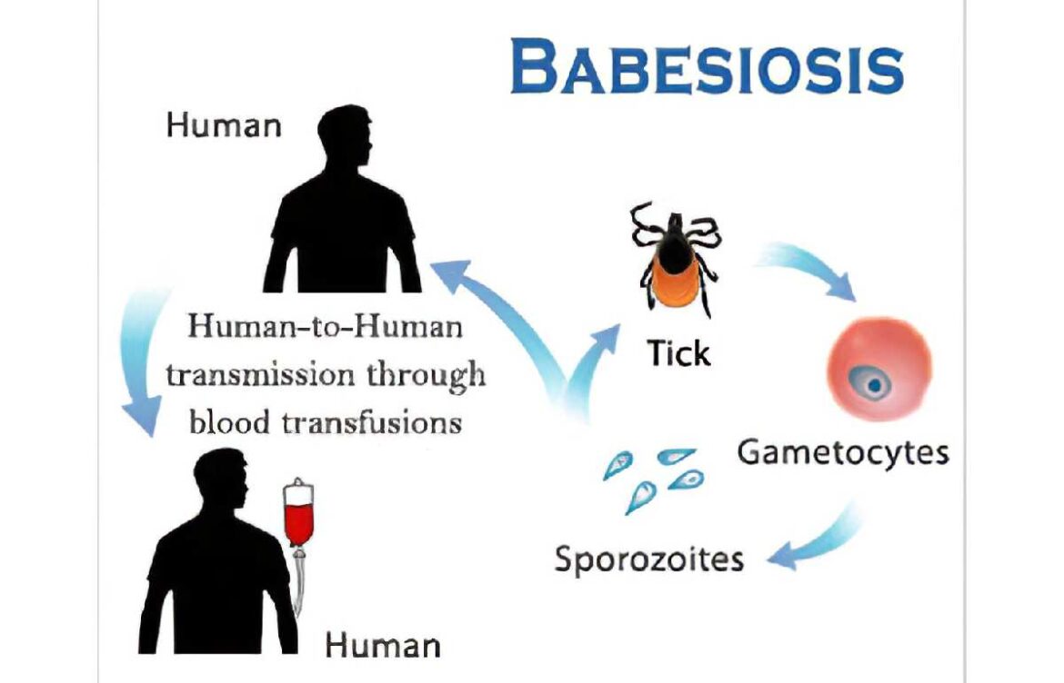 Babesiosis